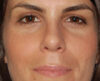 Rhinoplasty case #3809