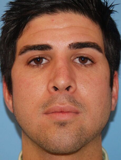 Rhinoplasty case #3816