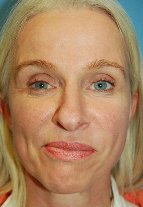 Rhinoplasty case #3821