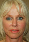 Rhinoplasty case #3821