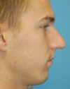 Rhinoplasty case #3824