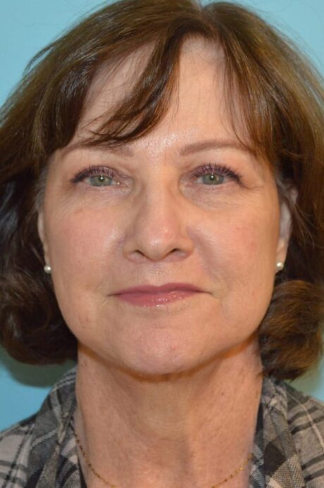 Eyelid Surgery case #3784