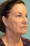 Eyelid Surgery case #3784