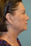 Eyelid Surgery case #3784
