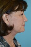 Eyelid Surgery case #3784