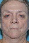 Eyelid Surgery case #3791