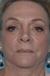 Eyelid Surgery case #3791