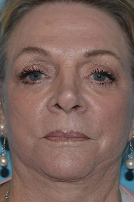 Eyelid Surgery case #3791