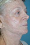 Eyelid Surgery case #3791