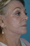 Eyelid Surgery case #3791