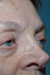Eyelid Surgery case #3791