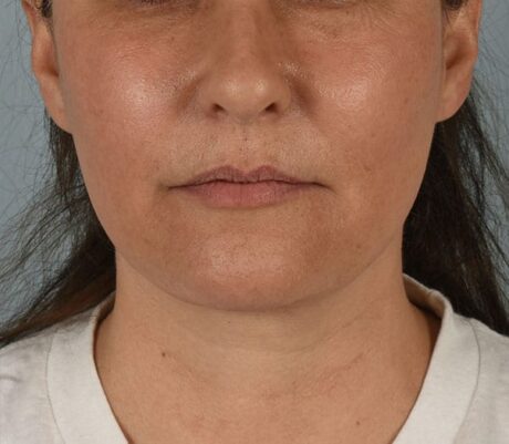 Facelift case #4275
