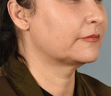 Facelift case #4275