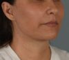 Facelift case #4275
