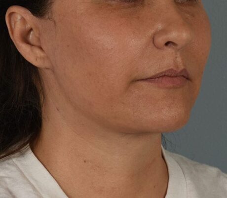 Facelift case #4275