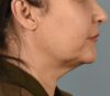 Facelift case #4275