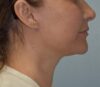 Facelift case #4275