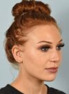 Rhinoplasty case #3830