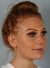 Rhinoplasty case #3830