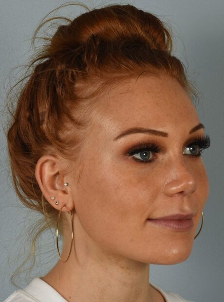 Rhinoplasty case #3830