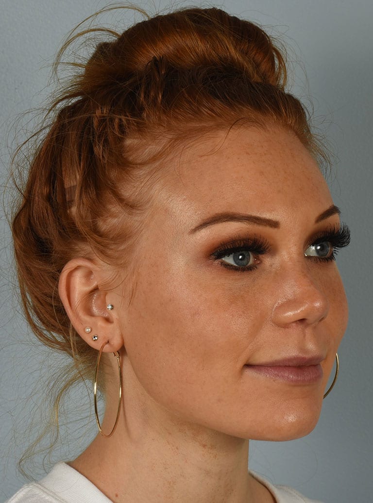 Rhinoplasty case #3830