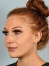Rhinoplasty case #3830