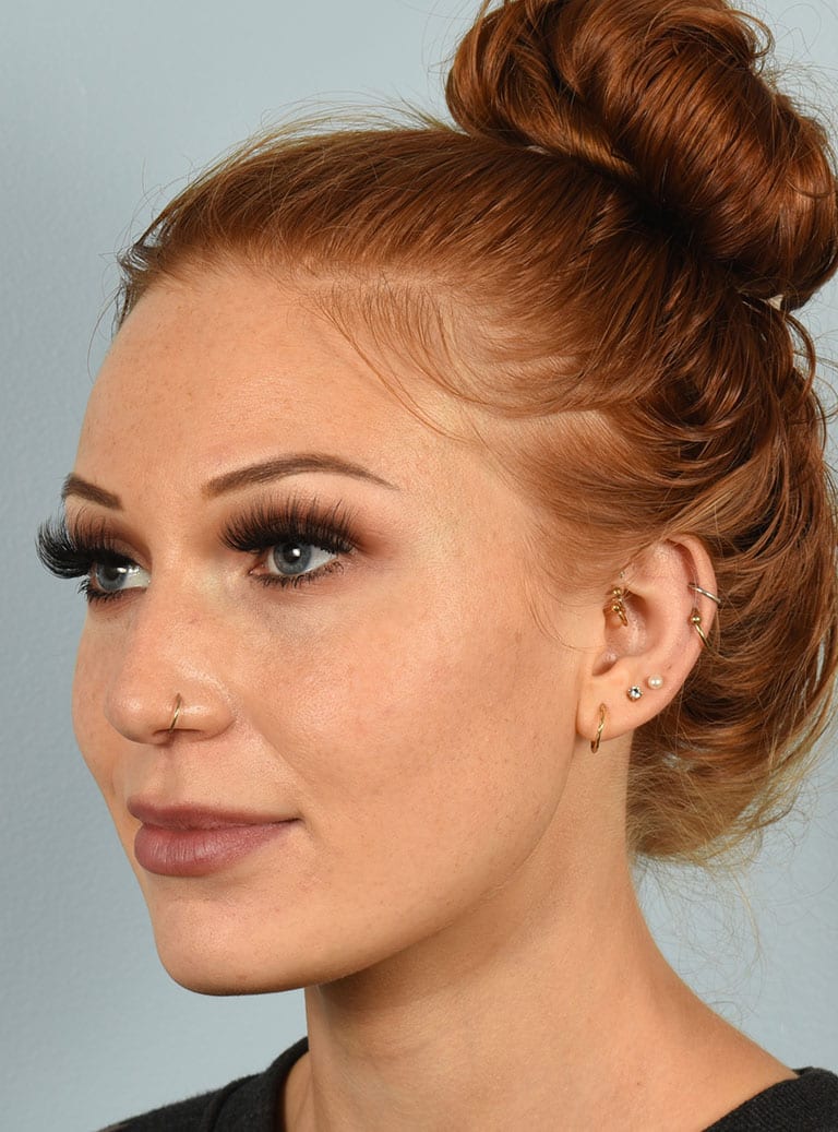 Rhinoplasty case #3830