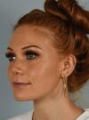 Rhinoplasty case #3830
