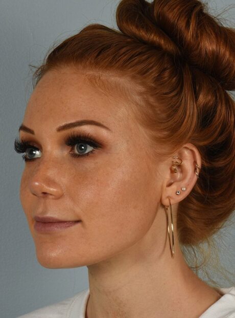 Rhinoplasty case #3830