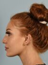 Rhinoplasty case #3830