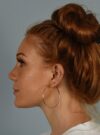 Rhinoplasty case #3830