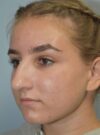 Rhinoplasty case #3839