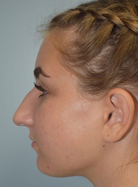 Rhinoplasty case #3839
