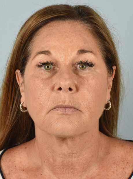 Neck Lift case #4821