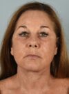 Neck Lift case #4821