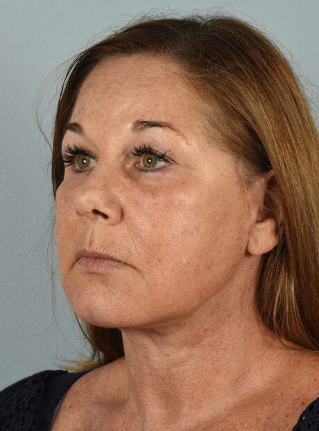 Neck Lift case #4821