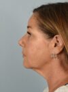 Neck Lift case #4821