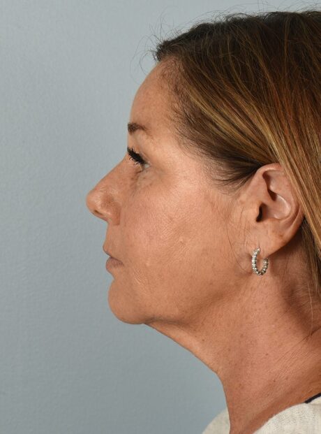 Neck Lift case #4821