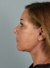Neck Lift case #4821
