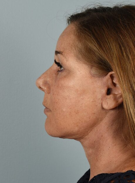 Neck Lift case #4821