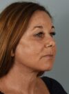 Neck Lift case #4821