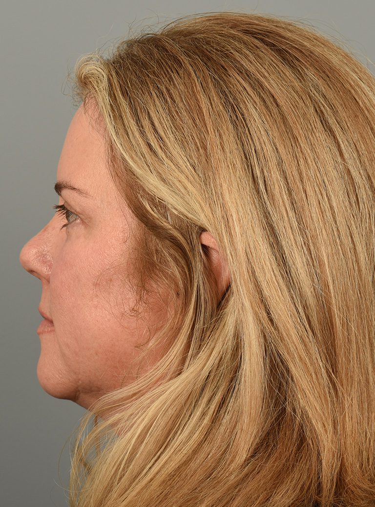 Fractional co2 Laser case #4490
