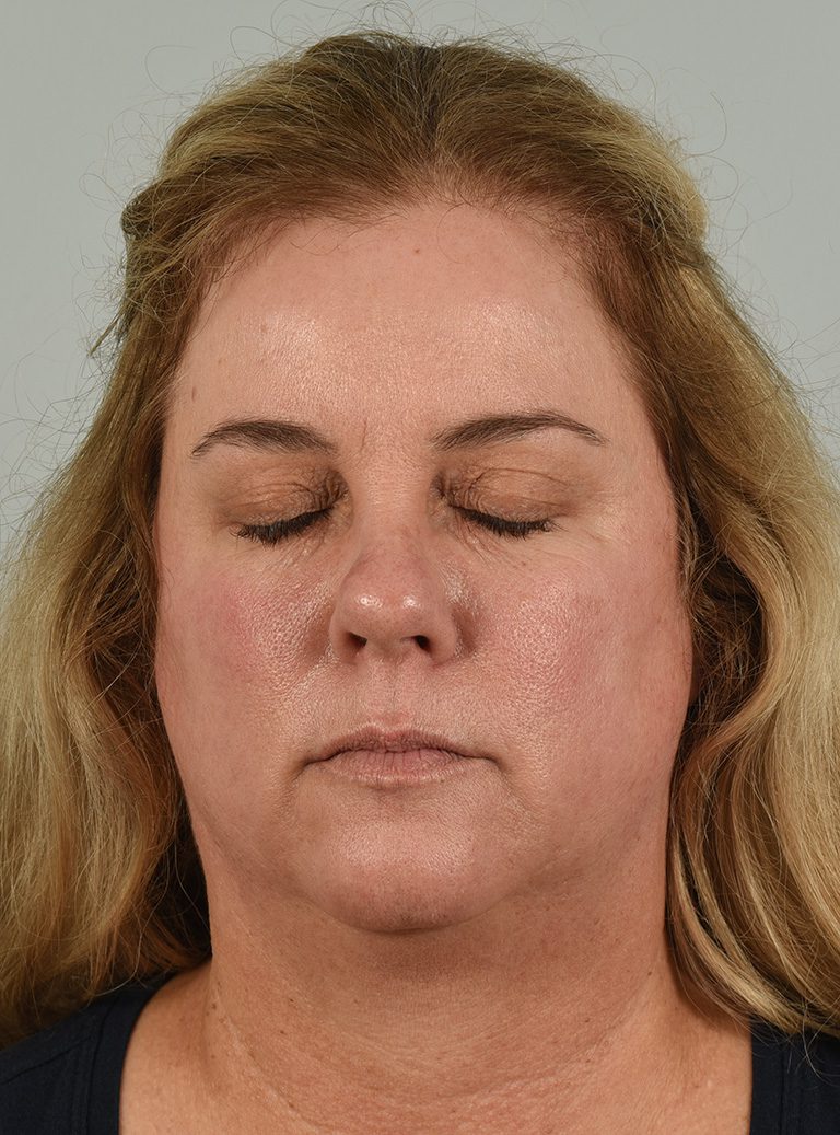 Fractional co2 Laser case #4490