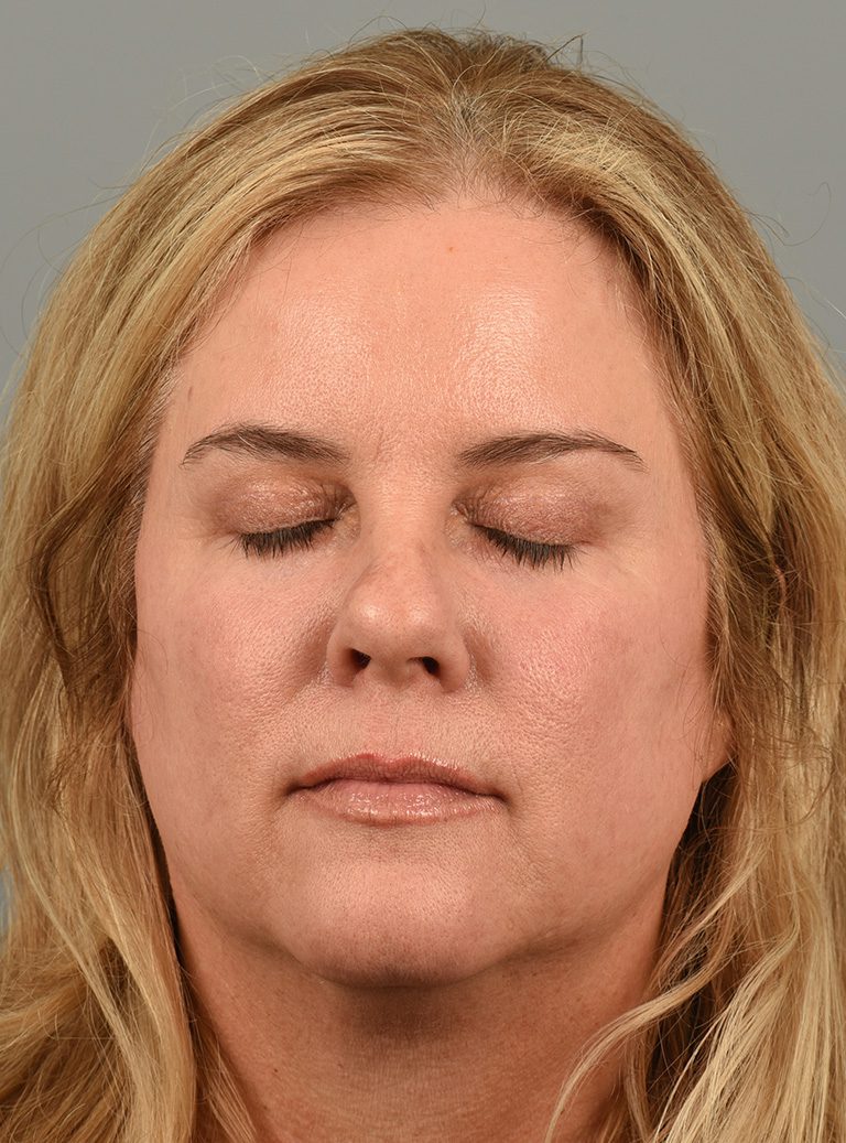 Fractional co2 Laser case #4490