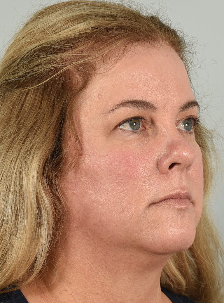 Fractional co2 Laser case #4490