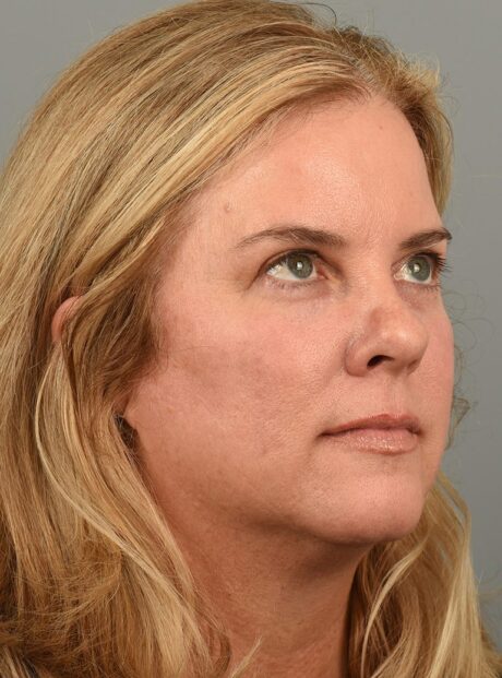 Fractional co2 Laser case #4490