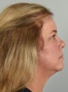 Fractional co2 Laser case #4490