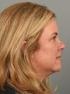Fractional co2 Laser case #4490