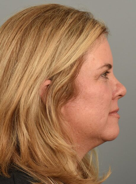 Fractional co2 Laser case #4490