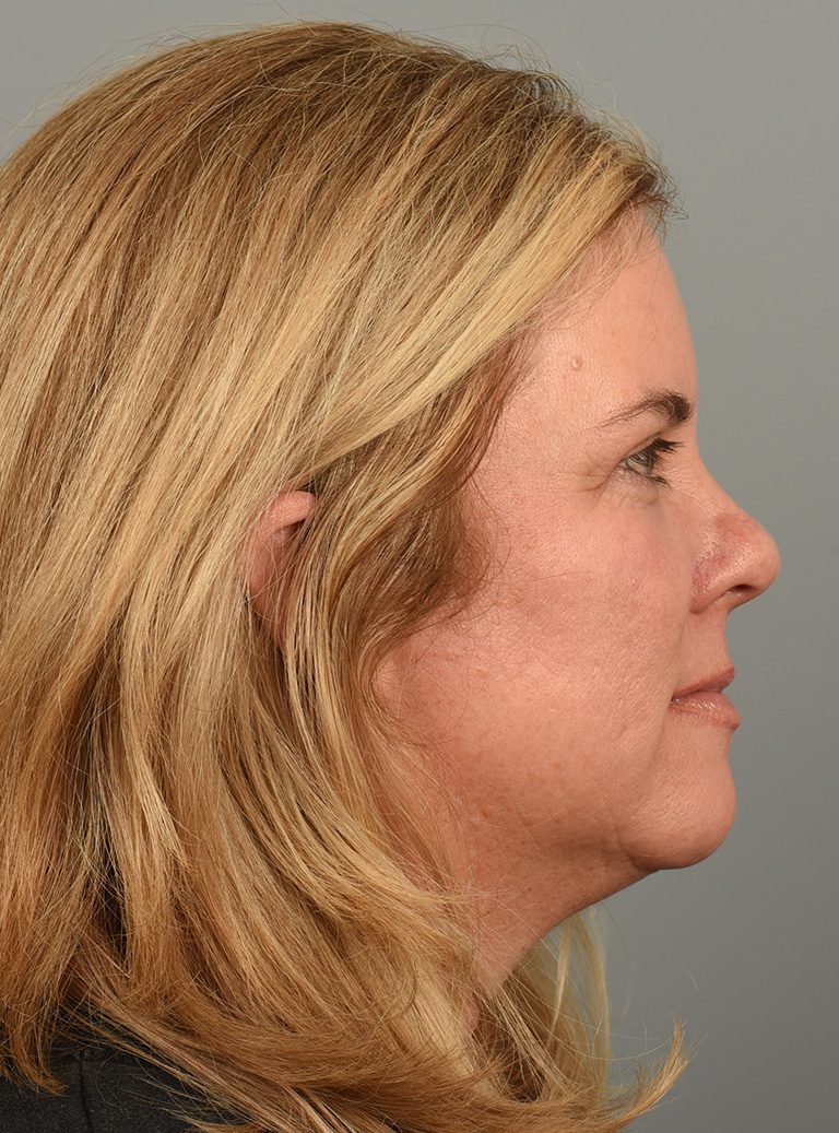 Fractional co2 Laser case #4490